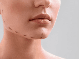 Mentoplastia o que é e quando realizar a cirurgia
