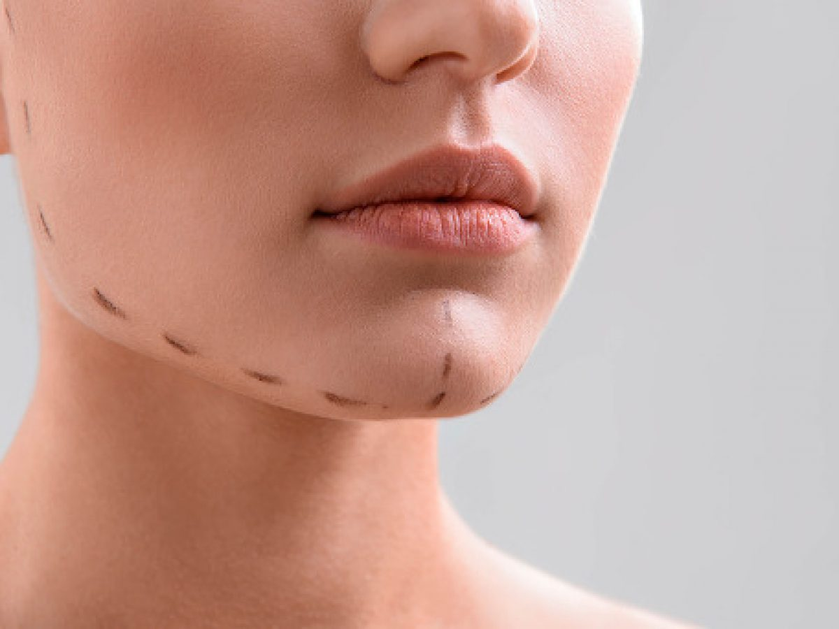 Mentoplastia o que é e quando realizar a cirurgia